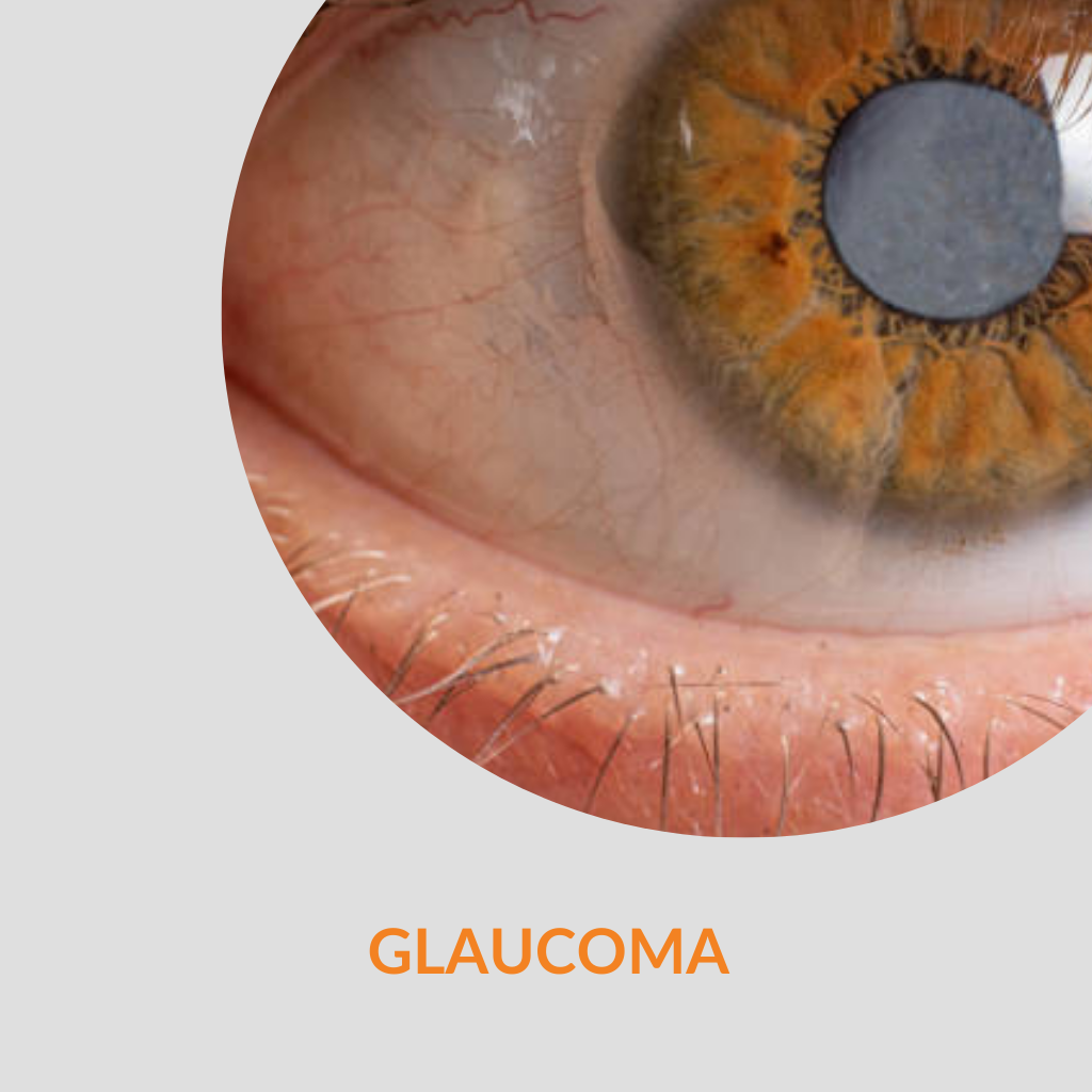 glaucoma-treatment-in-kalyan