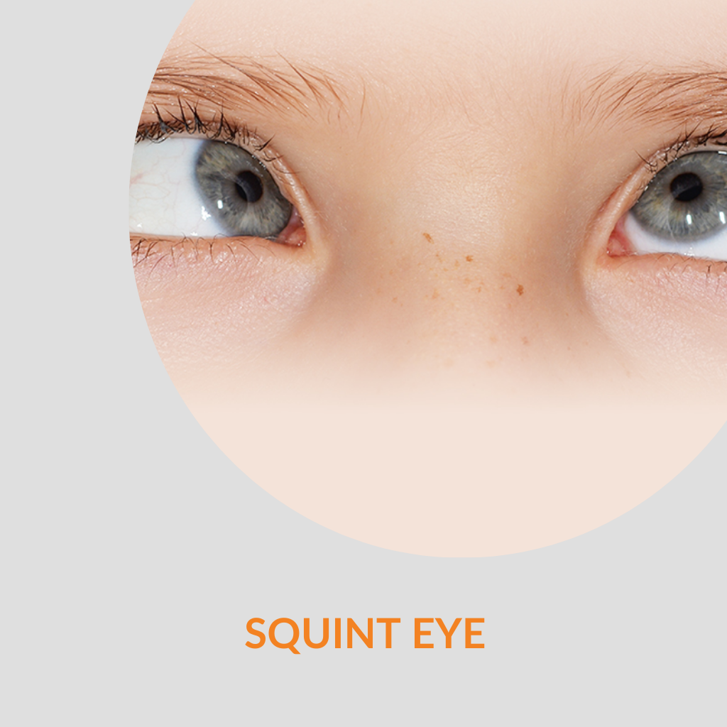 squint-eye-surgery-in-kalyan